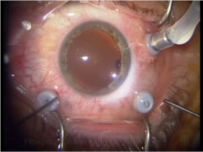 Cirugías del vítreo y la Retina