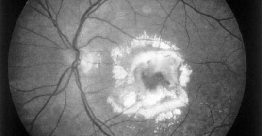 Estudio de Fluorangiografía de Retina